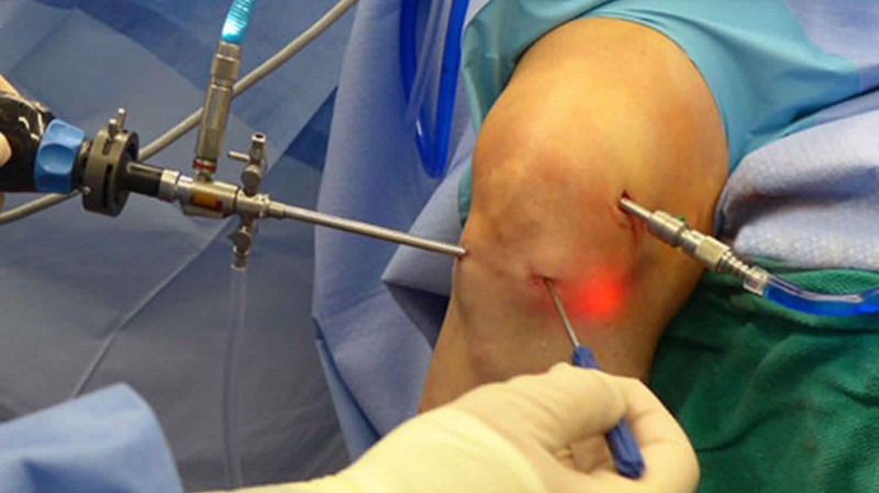 Arthroscopy Asset Image