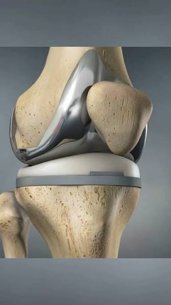 Knee Replacement Asset Image